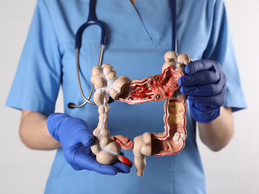 O alimento que reduz em 20% o risco de câncer de intestino, segundo novo estudo