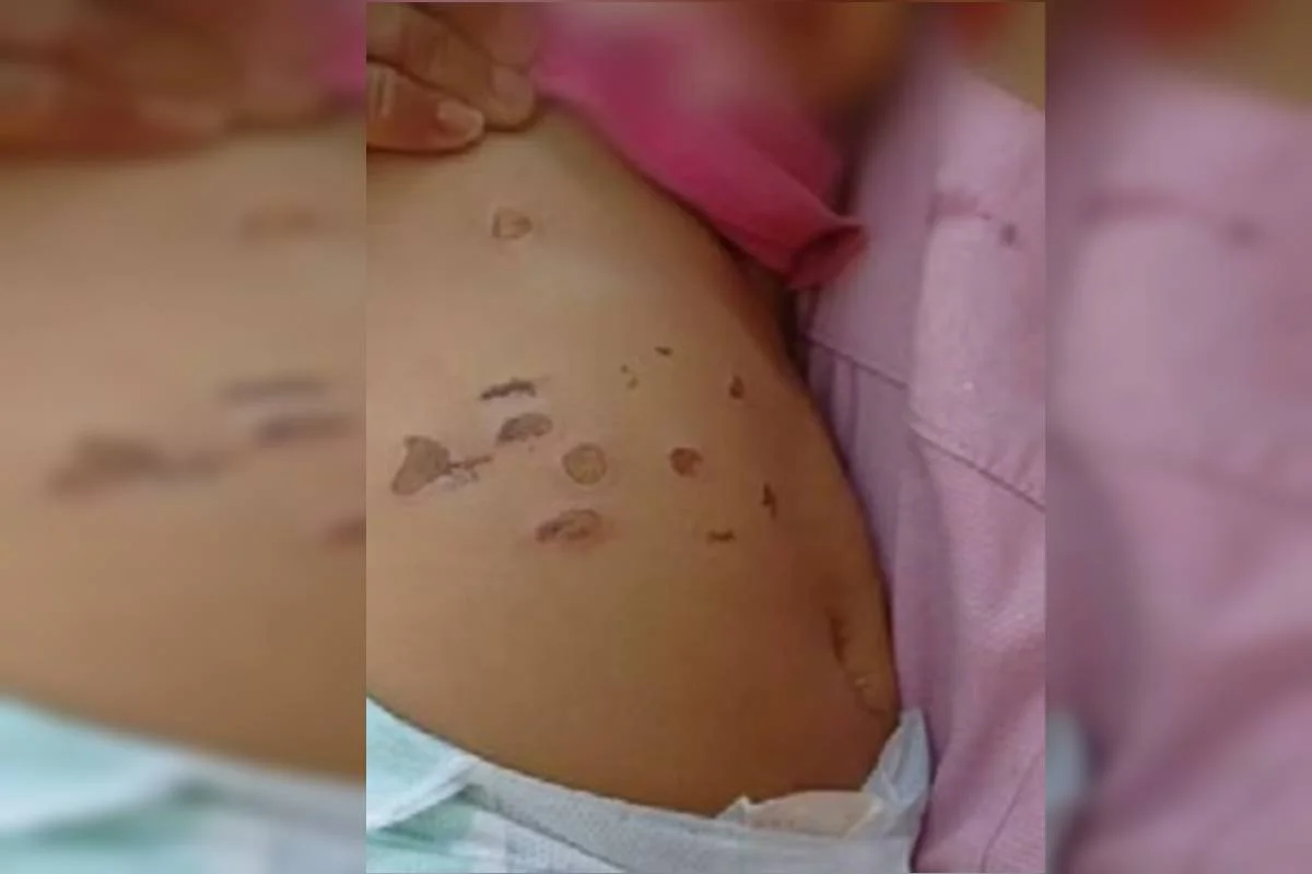 Menina de 10 meses foi queimada com cigarros na barriga e nas pernas