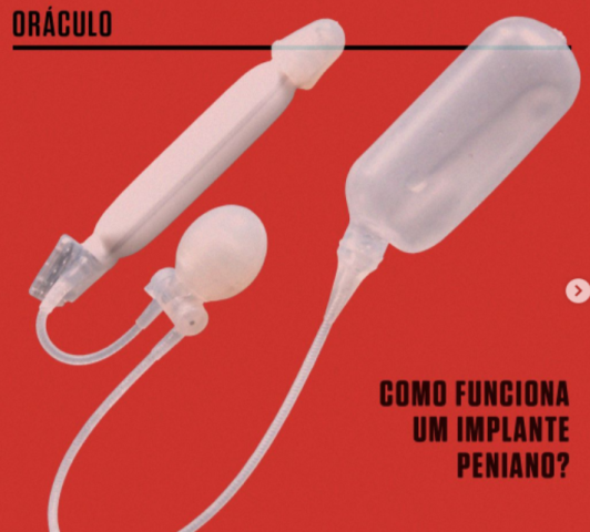 Exército: Aprenda como funciona a prótese peniana