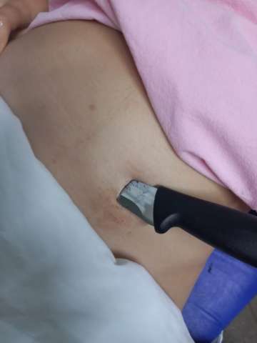 Grávida é esfaqueada por bandidos em tentativa de assalto em Extremoz