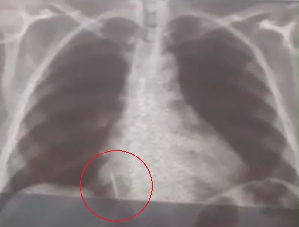 Broca de dentista se solta durante atendimento e vai parar dentro de pulmão de paciente no RN
