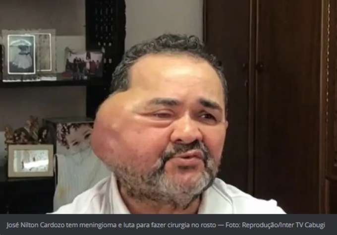 Drama no RN: Idoso com tumor gigante no rosto não consegue cirurgia nem com decisão judicial