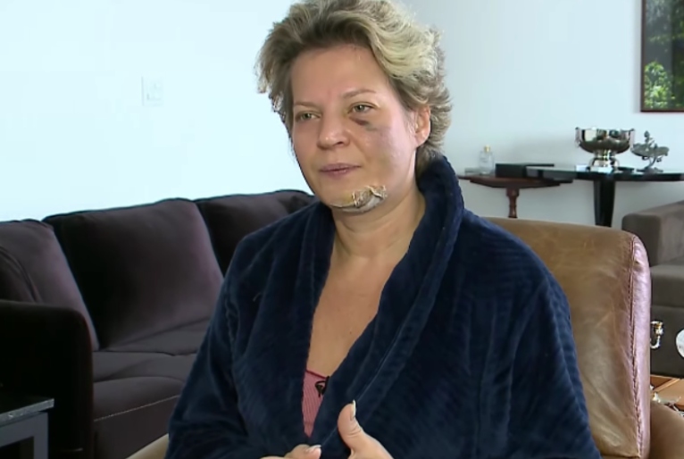 Com fraturas no rosto e corpo, Joice Hasselmann suspeita ter sido vítima de atentado
