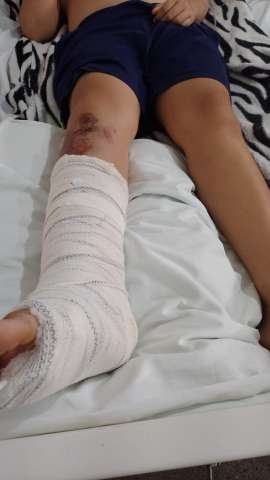 Com perna fraturada, criança de 12 anos espera por cirurgia desde quarta, em Caicó; saiba o motivo