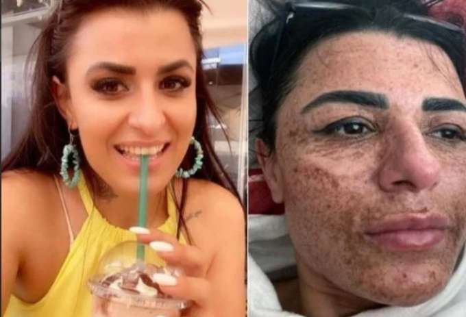 Esteticista se distrai em briga com namorado e queima rosto de cliente