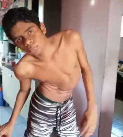Potiguar de 18 anos com doença rara consegue na justiça cirurgia de urgência e luta contra o tempo pela vida